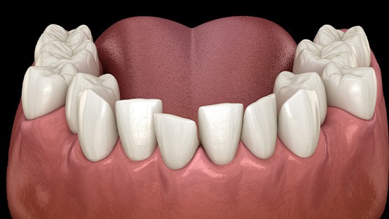 Illustration of crooked teeth