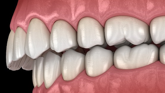 Illustration of an overbite