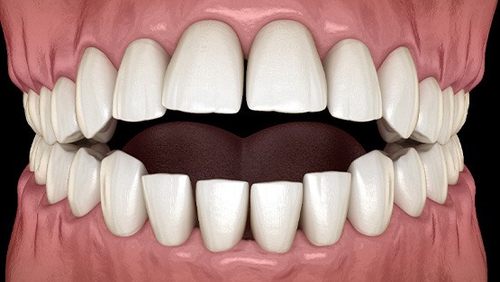 Illustration of an open bite