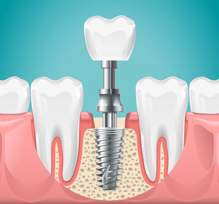 removing-a-failed-dental-implant-powdersville-dr-darryl-halbert