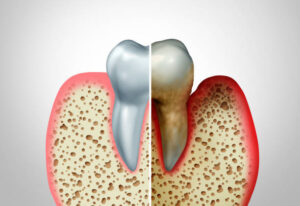 Healthy gums compared to diseased gums